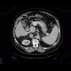 Myelolipoma of adrenal gland, liver cirrhosis, portal vein thrombosis: CT - Computed tomography